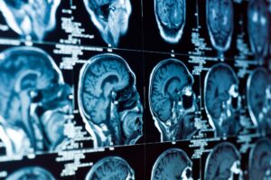 Traumatic Brain Injuries Alabama